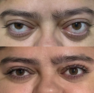 antes e depois - 32_1x