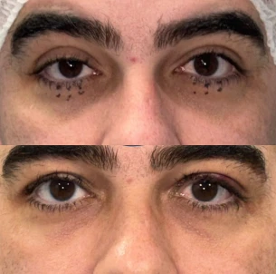 antes e depois - 33_1x
