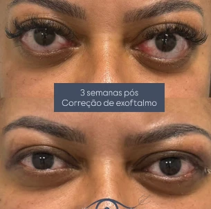 antes e depois - 34_1x