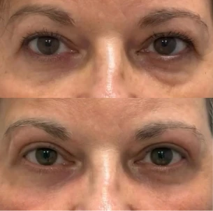 antes e depois - 35_1x